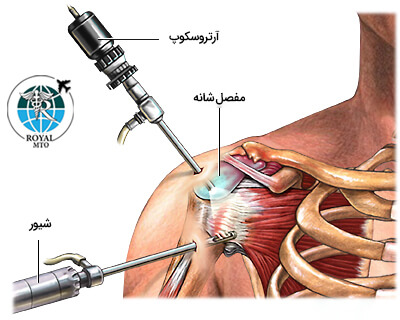 جراحی آرتروسکوپی تاندون های شانه