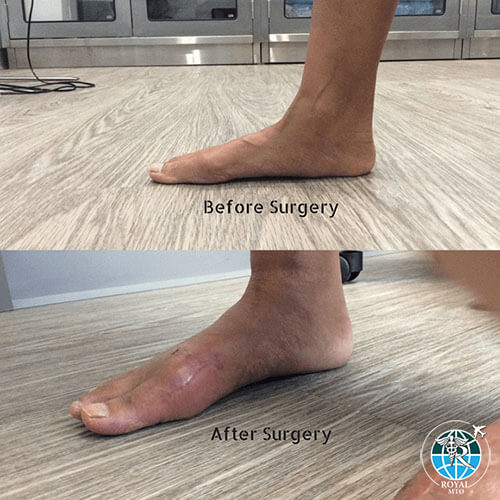 قبل و بعد از جراحی اصلاح بد شکلی کف پای صاف